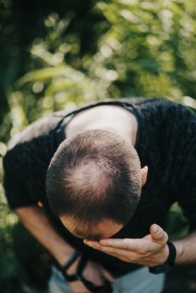 male pattern baldenss treatments for men in Ogden UT